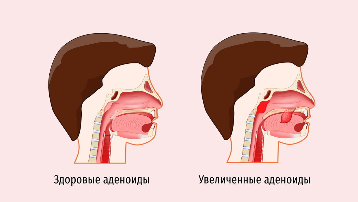 Аденоиды (аденоидит)